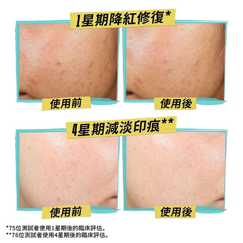 醫學水楊酸抗粉刺啫喱乳霜